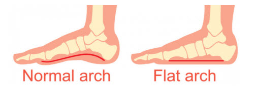 Flat Arch Feet Vs Normal Arch