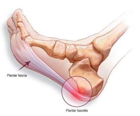 Wheeling IL Chicago Plantar Fasciitis Treatment Services
