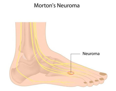 mortons neuroma