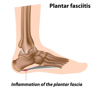 plantar faciitis e1615378667997 370x340